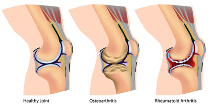 Arthritis-Knee_1.jpg